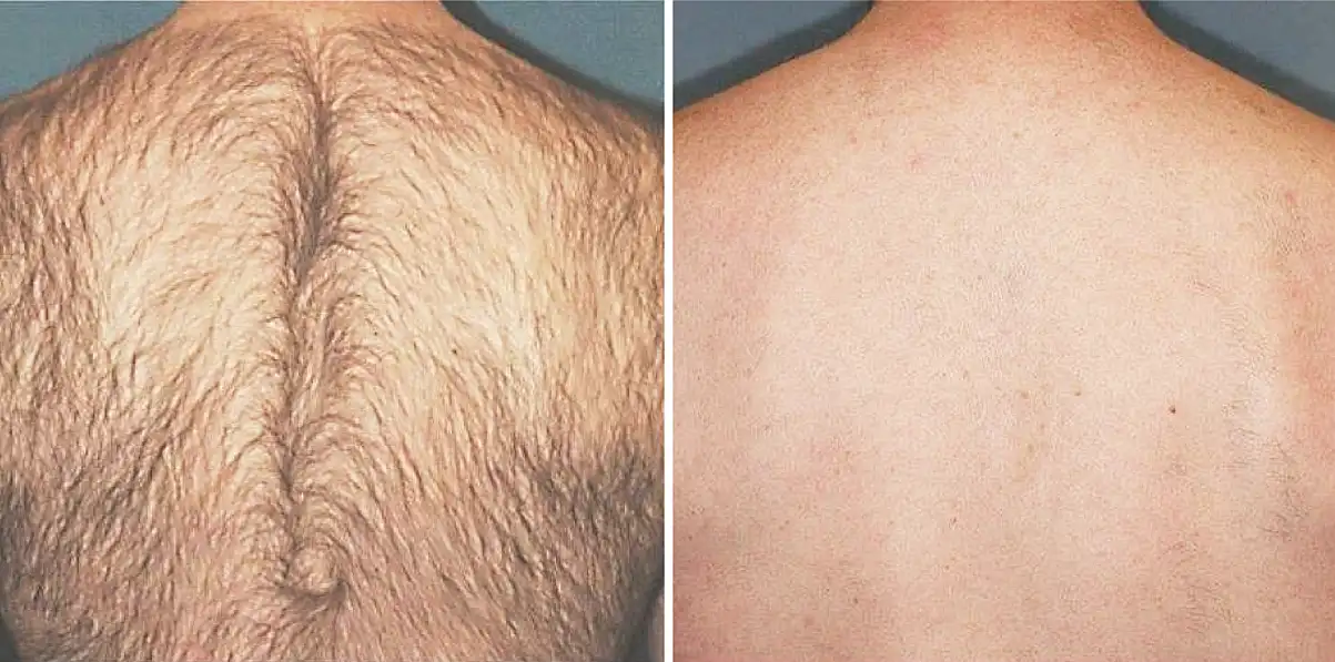 Back Laser Hair Removal Before & After