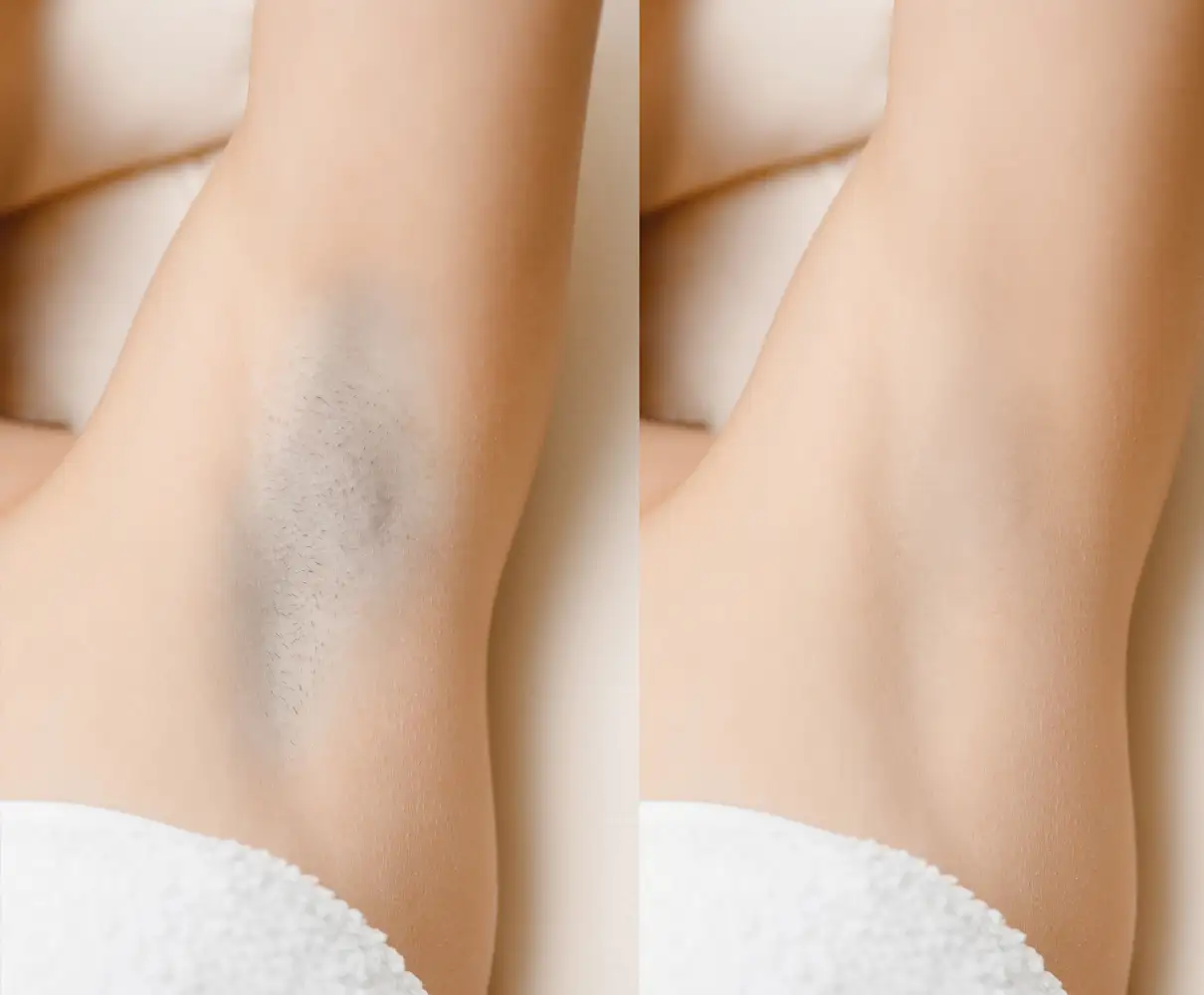 UnderArm Laser Hair Removal Before & After